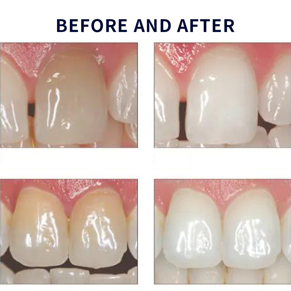 Opalescence Whitening 20% PF 2 - Teeth Whitening Singapore 评论和价格