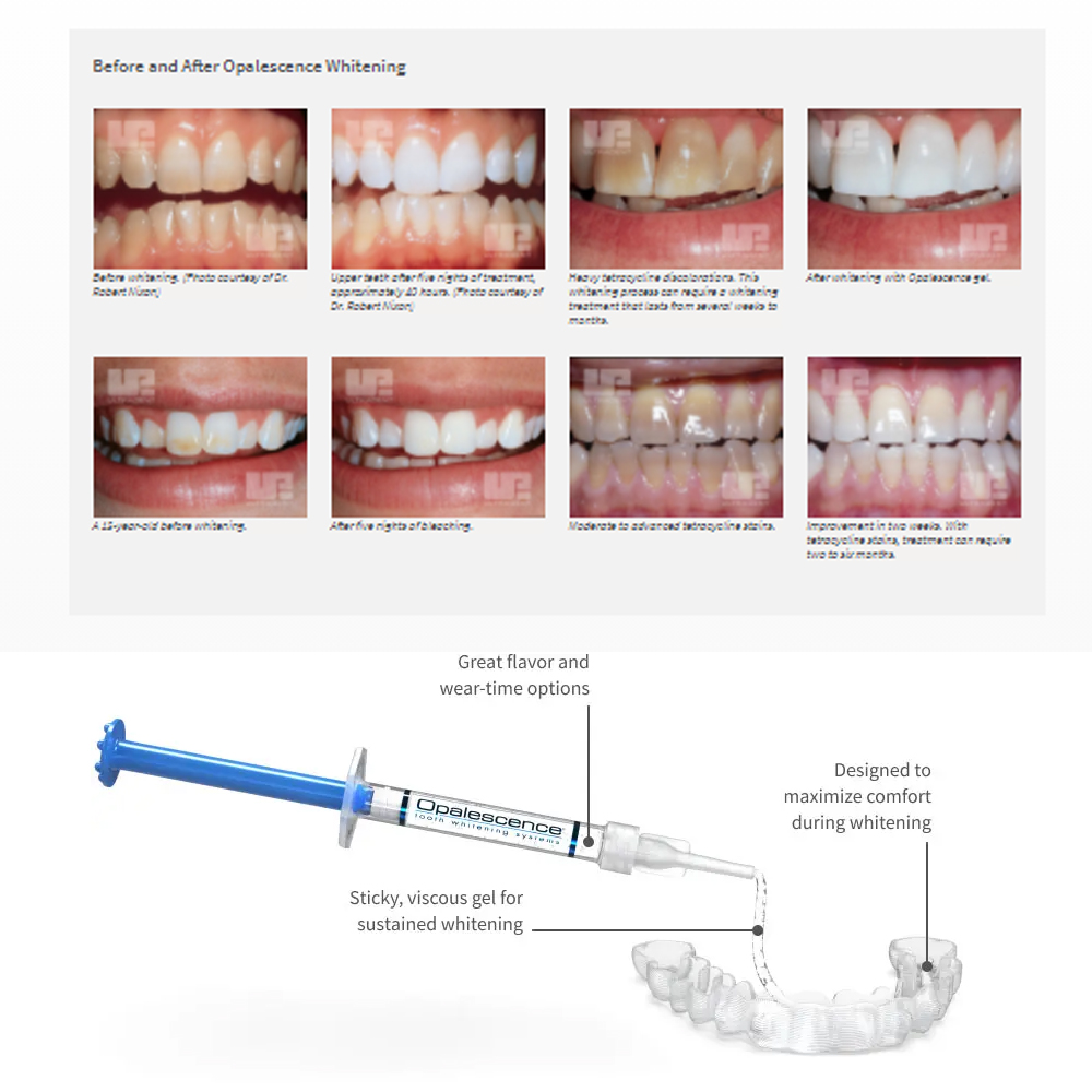 Opalescence Whitening 20% PF 2 - Teeth Whitening Singapore 评论和价格