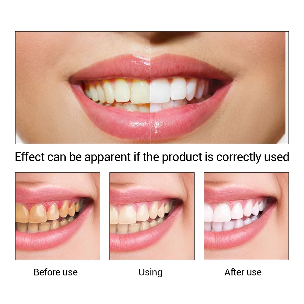 FTEENPLY Teeth Whitening Essen - Teeth Whitening Hismile 评论和价格