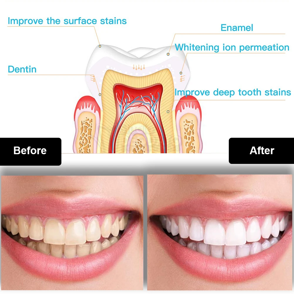 Dental Teeth Whitening Kit Min - Teeth Whitening Singapore 评论和价格
